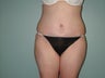 Tummy Tuck