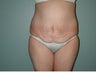 Tummy Tuck