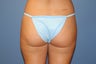 Smart Lipo
