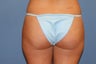 Smart Lipo
