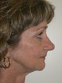 Rhinoplasty