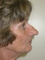 Rhinoplasty