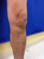 35 year old male with severe varicose veins 