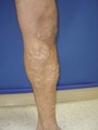 35 year old male with severe varicose veins 