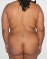 28 years old female treated for lipodistrofy on her back ( fat exces on her back)