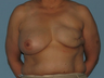 Received a left breast implant and a Breast Reconstruction after tissue expansion.