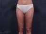 Liposuction Inner & Outher Thighs