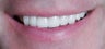 Dental Crown