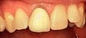 Dental Crown