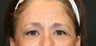 Lower Eyelid Blepharoplasty