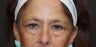 Lower Eyelid Blepharoplasty