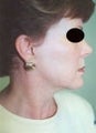 40 year old female patient 
