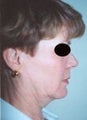 40 year old female patient 