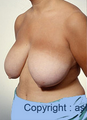 Breast Reduction
