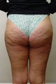 Liposuction