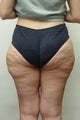 Liposuction