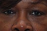 Eyelid Surgery