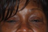 Eyelid Surgery
