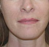 Status Post Mini Face Lift