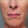 Status Post Mini Face Lift