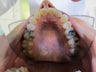  Invisalign