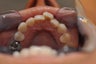  Invisalign
