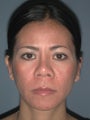 Otoplasty, Ear Surgery