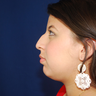 Chin Surgery