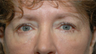 59 year old woman with lower lid bags treated with fat repositioning blepharoplasty