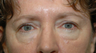 59 year old woman with lower lid bags treated with fat repositioning blepharoplasty