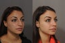 Rhinoplasty
