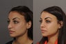 Rhinoplasty