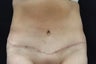 Tummy Tuck