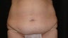 Tummy Tuck