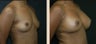 Breast Augmentation