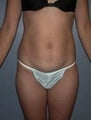 38 year old female patient 