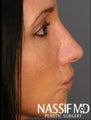 Rhinoplasty