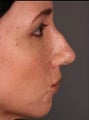 Rhinoplasty