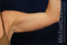 Arm Lift