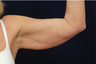 Arm Lift