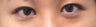 Asian Eyelid Surgery
