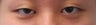 Asian Eyelid Surgery