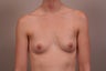 Breast implants