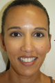 Ear reshaping was accomplished on the left ear to match her right ear.  This is called a unilateral Otoplasty.