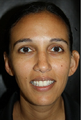 Ear reshaping was accomplished on the left ear to match her right ear.  This is called a unilateral Otoplasty.