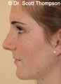 Rhinoplasty