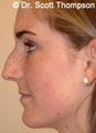 Rhinoplasty