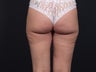 Liposuction Inner & Outer Thighs