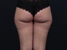 Liposuction Inner & Outer Thighs