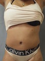 Tummy Tuck Revision